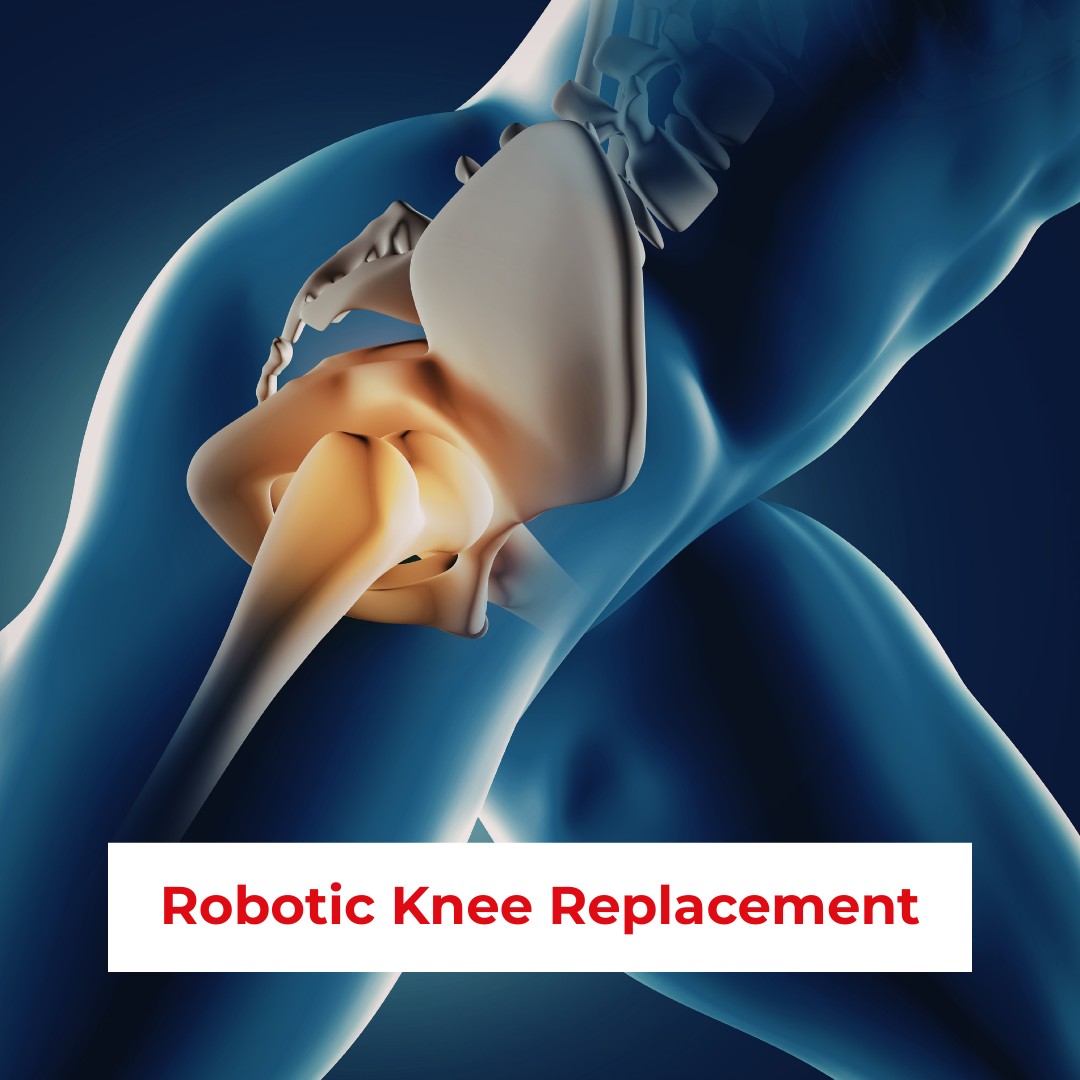 Robotic Knee Replacement in Patna, Bihar