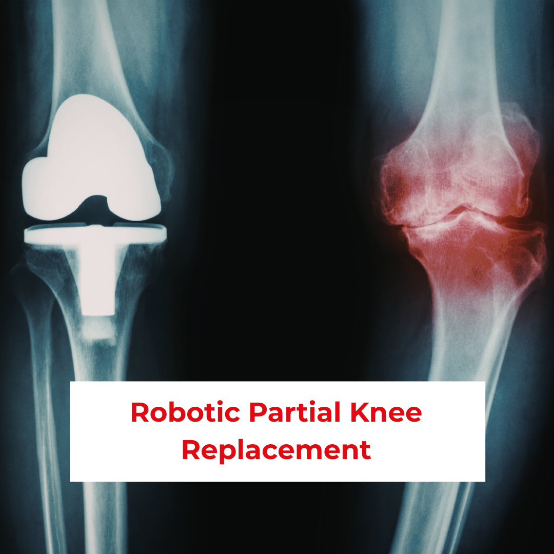 Robotic Partial Knee Replacement in Patna, Bihar